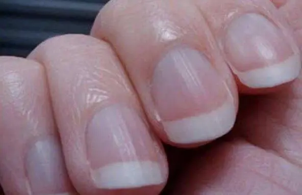Vertical lines appear on the nails? It may be related to these 4 hidden  health hazards, don't take it seriously! | DayDayNews