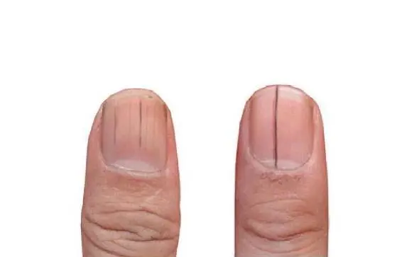 Vertical lines appear on the nails? It may be related to these 4 hidden  health hazards, don't take it seriously! | DayDayNews